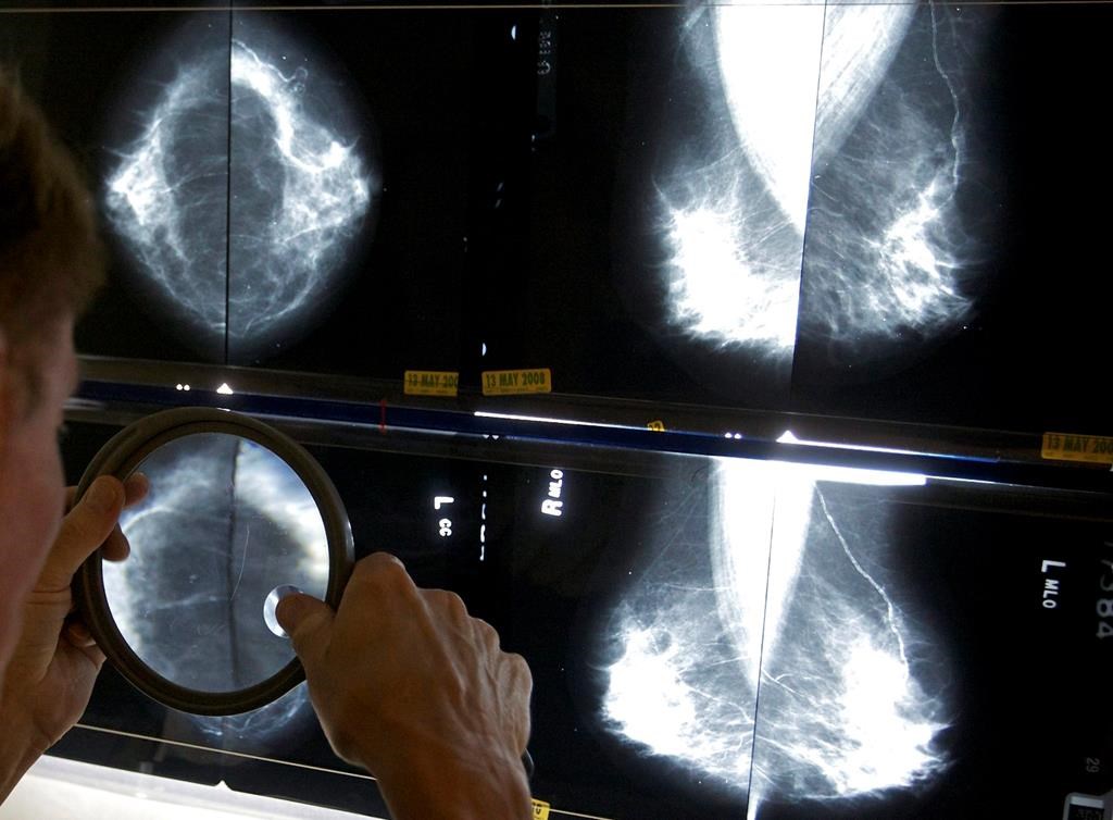 Hausse alarmante des cas de cancer du sein chez les jeunes femmes