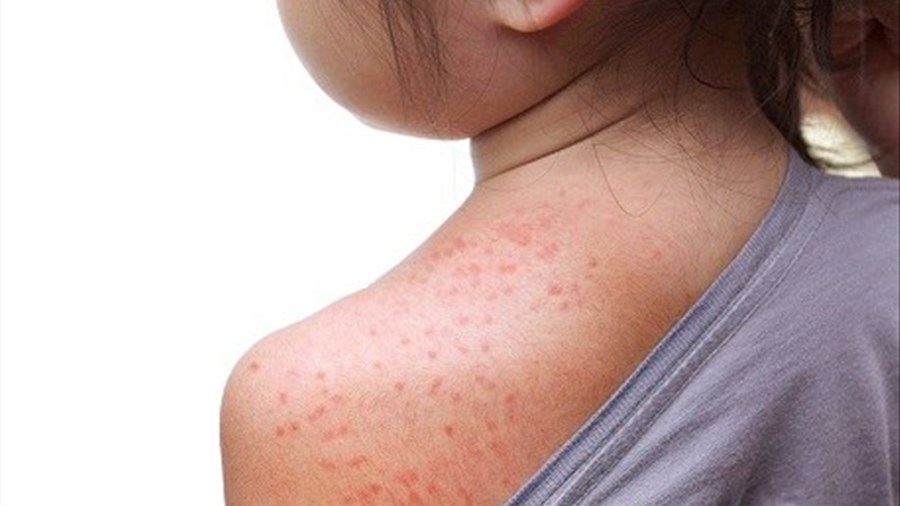 Six cas de rougeole dans les Laurentides, Laval et Lanaudière