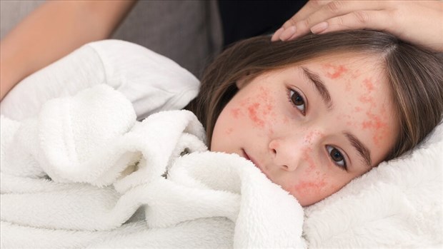 Nouveaux cas de rougeole dans Lanaudière